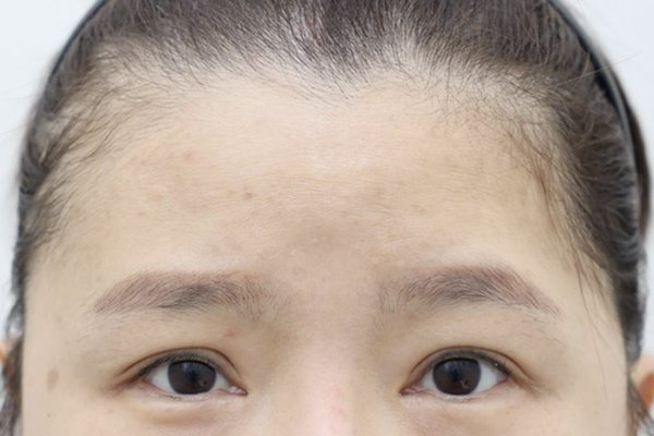 이마성형 전후사진 4 시술 전