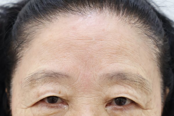 이마성형 전후사진 6 시술 전