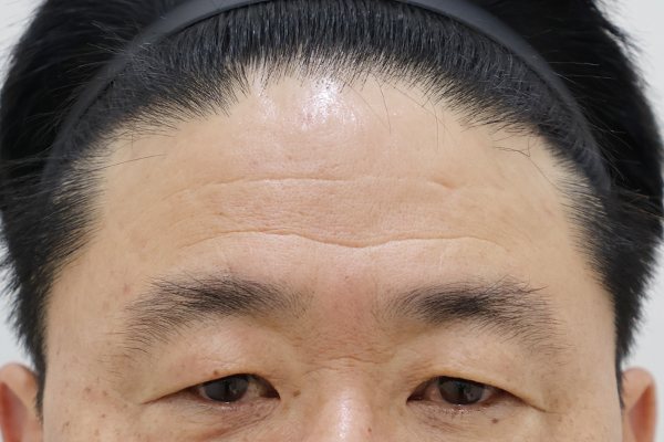 이마성형 전후사진 8 시술 전
