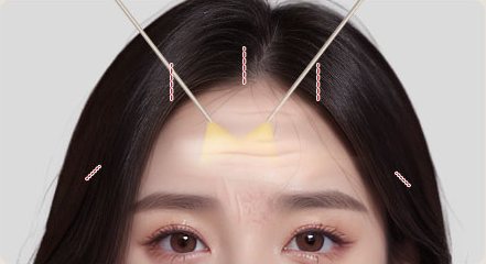 STEP 03 박리·절제 부위 표시