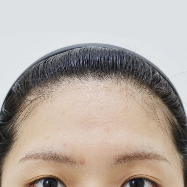 내시경 이마거상 시술 전