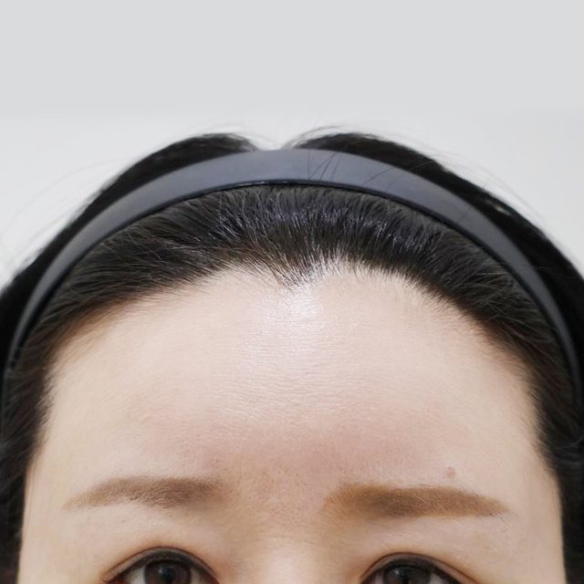 내시경 이마거상 시술 전