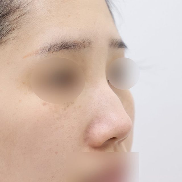 코재수술 시술 전