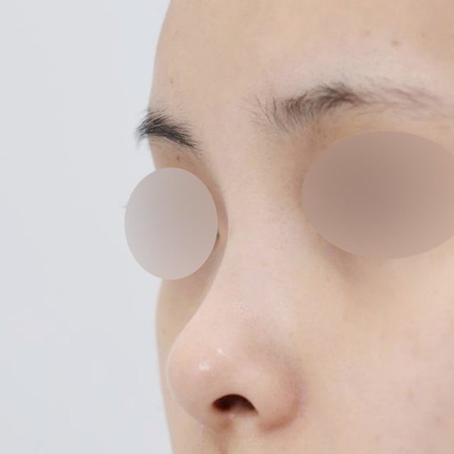 코성형 시술 전