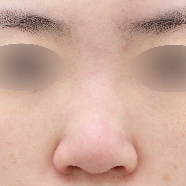 코성형 시술 전