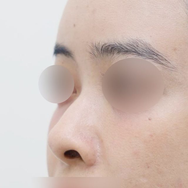 코재수술 시술 전