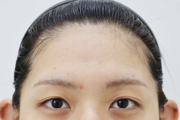 이마성형 전후사진 1 시술 전