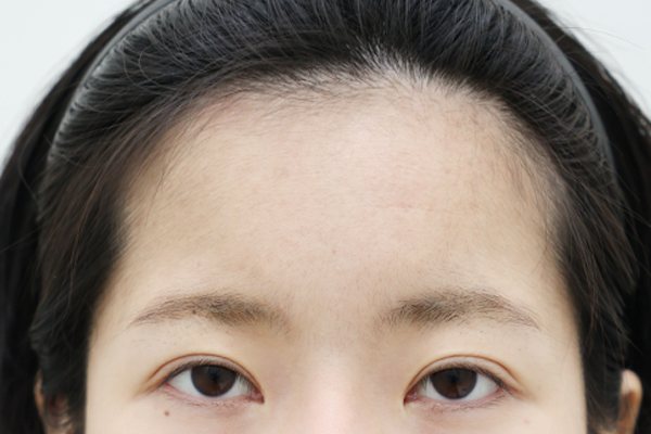 이마성형 전후사진 2 시술 전