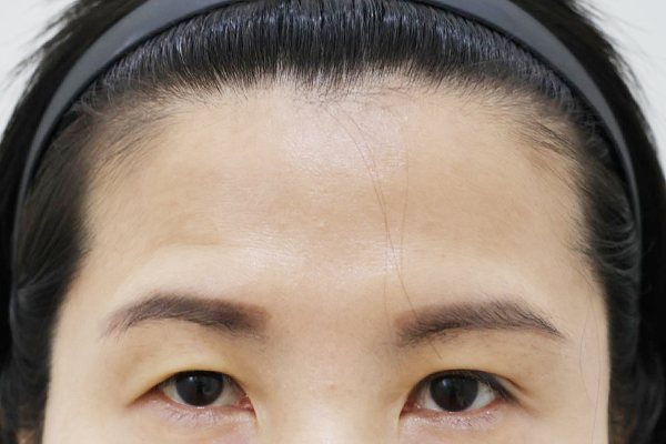 이마성형 전후사진 3 시술 전