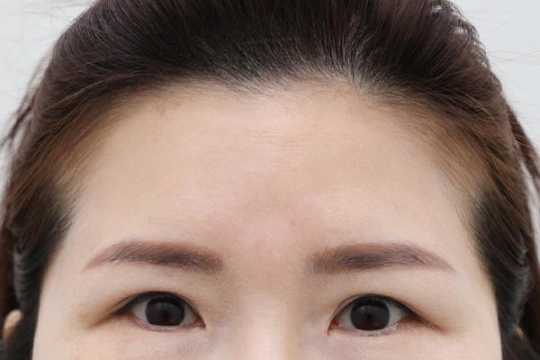 이마성형 전후사진 5 시술 전