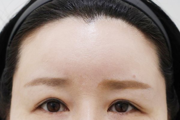 이마성형 전후사진 7 시술 전