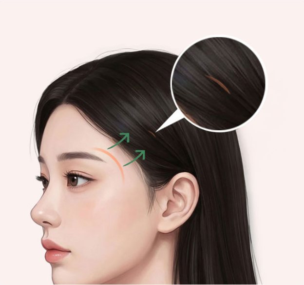 측두부 거상 — 옆얼굴 일러스트와 측두부 절개선 확대 원