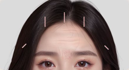 STEP 01 헤어라인 안쪽 절개 위치 표시