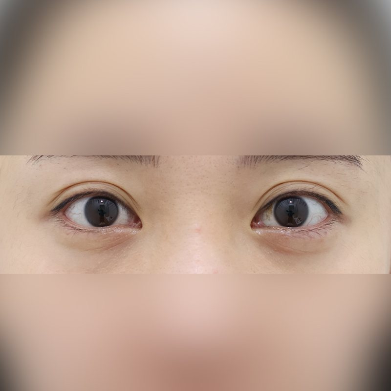 쌍꺼풀 시술 전