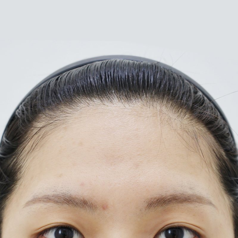 내시경 이마거상 시술 전