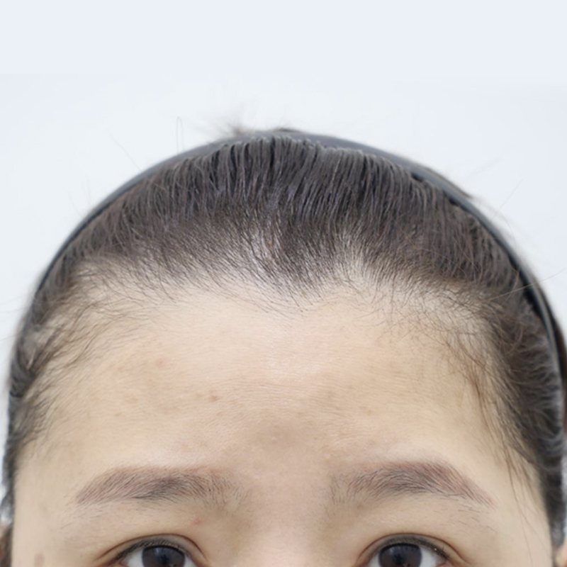 내시경 이마거상 시술 전