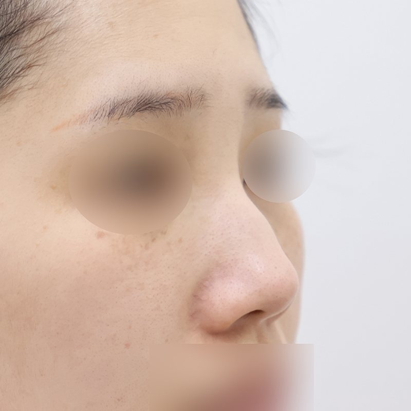 코재수술 시술 전
