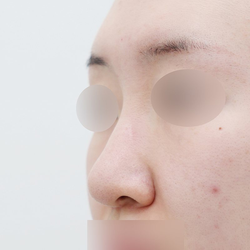 코재수술 시술 전