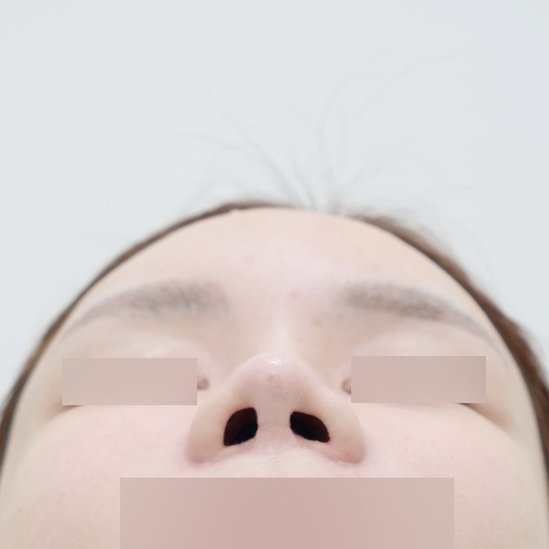 코재수술 시술 전