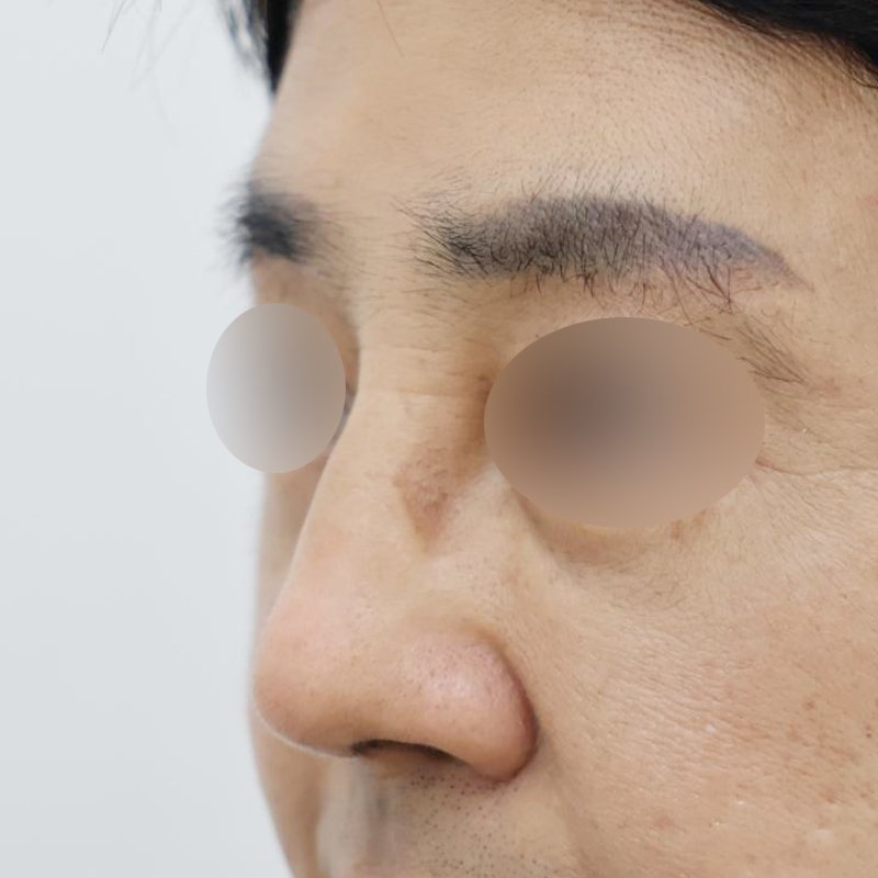 코재수술 시술 전